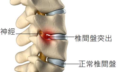 針刀05